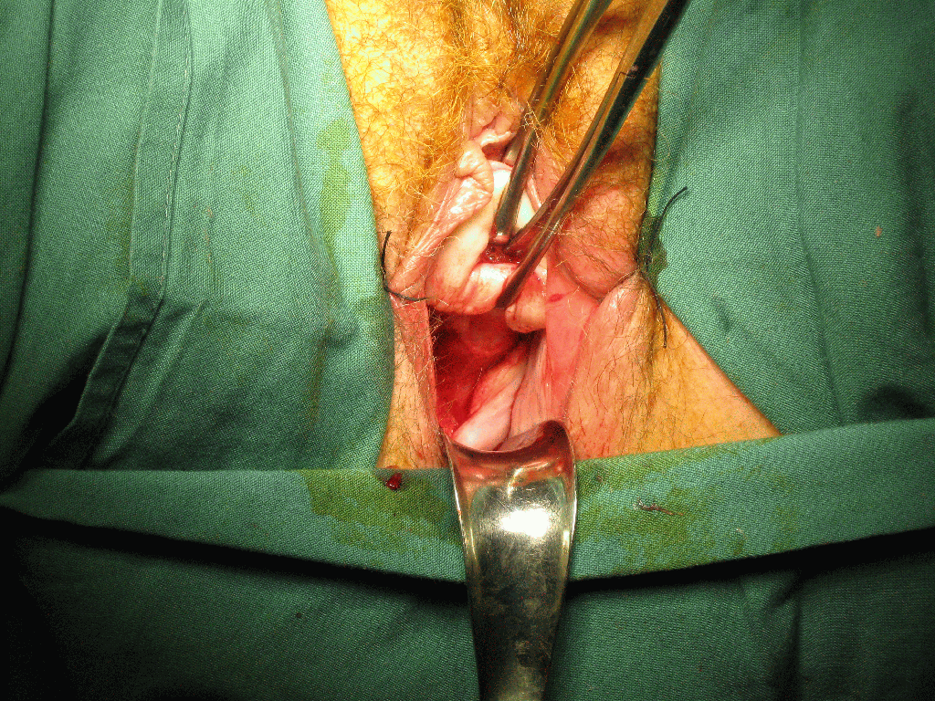 vaginal hysterectomy 1